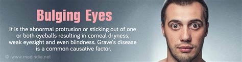 Bulging Eyes Eye Proptosis Exophthalmos Causes Symptoms