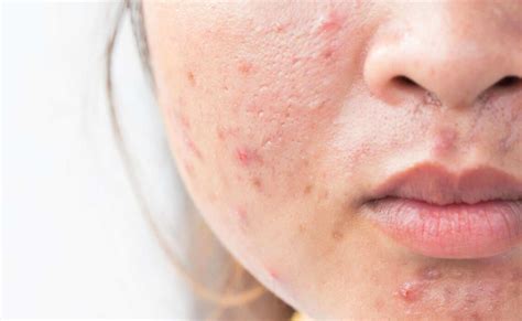 What Are The Different Types Of Acne Scars Suntrics