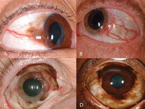 A Guide To Conjunctival Tumors
