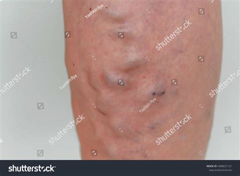 Varicose Veins Elderly Woman Inflamed Dilated Stock Photo 1688631121
