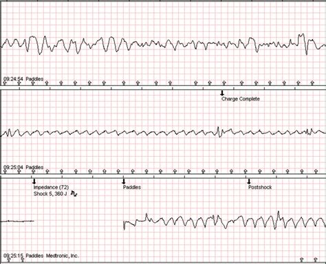 Case 8 Double External Sequential Defibrillation Shock 5 56 Minutes