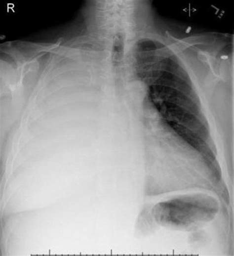 An ipc is sometimes more effective if the effusion is present on both sides of the chest (bilateral) or if there are large areas of localized fluid collections (loculated. Chest X-ray showing right sided pleural effusion. | Open-i