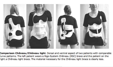 A Comparison Of Two Current Brace Types Used In Scoliosis