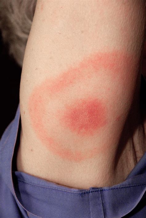 Look Out For Lyme Disease This Summer Golf Blog