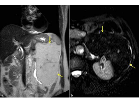 Giant Angiomyolipoma Mri Coronal T2 Weighted A And Stir Sequence