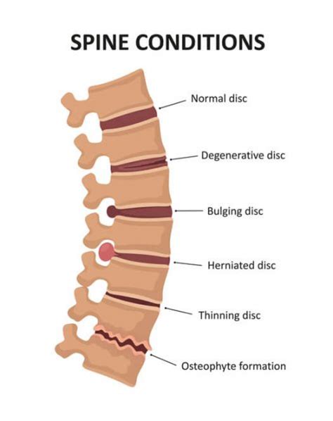 Bulging Disc Vs Herniated Disc Whats The Difference The Orthopedic