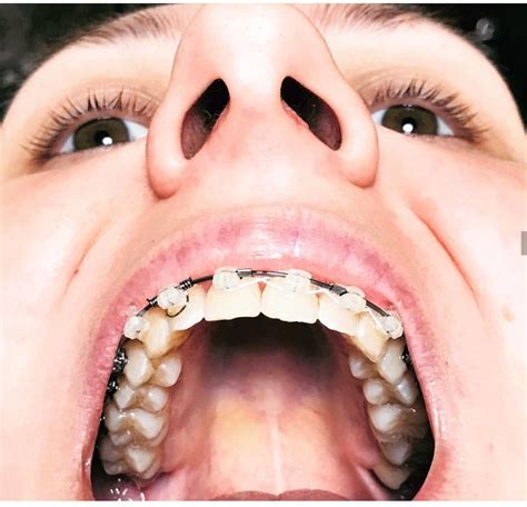 「braces And Retainers Orthodontics」おしゃれまとめの人気アイデア｜pinterest｜jamie Richie 歯科
