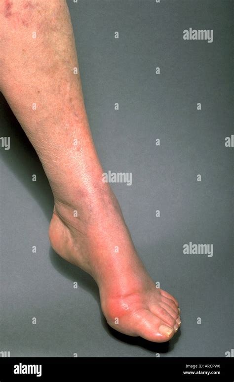 Gout Foot Hi Res Stock Photography And Images Alamy