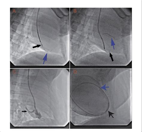 Figure E Transvenous Puncture Of The Acute Margin Of The Rv And