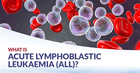 What Is Acute Lymphoblastic Leukaemia All Cfch Centre For