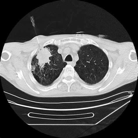 Contrast Enhanced Computed Tomography Ct Scan 2 Months After The