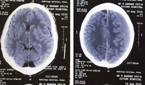 Left Acute Subdural Hematoma A Left Subacute Subdural