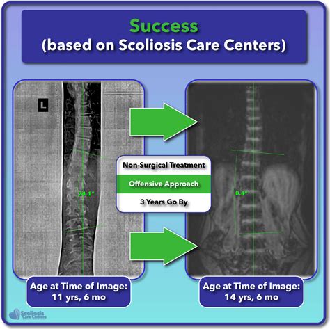 Scoliosis Treatment For Children And Teens Scoliosis Care Centers