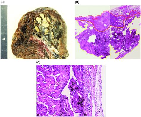 Want to learn more about it? (a) Gross appearance showing large cysts replacing lung parenchyma. (b)... | Download Scientific ...