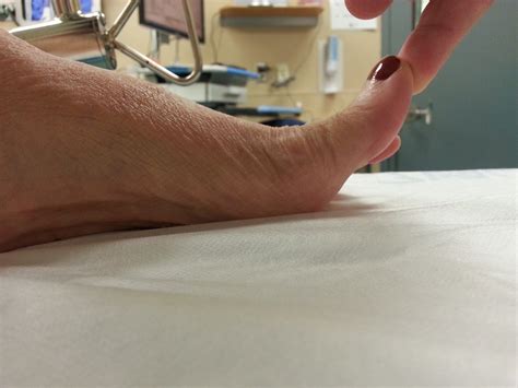 Pre Op Painful Hallux Limitus Advanced Foot And Ankle Center Of San Diego
