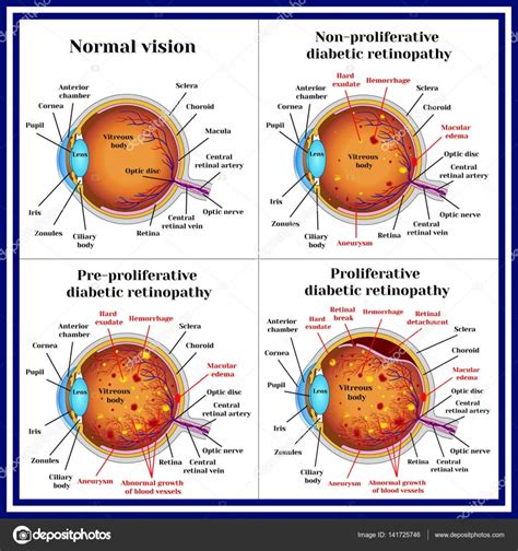Consistent screening of diabetic retinopathy is essential in order to avoid further. Types of diabetic retinopathy — Stock Vector © mrs.bazilio ...
