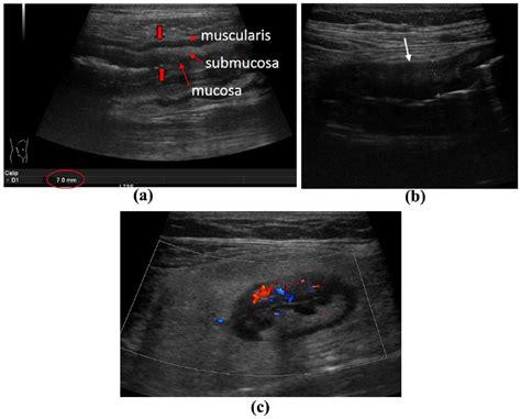 Intestinal Ultrasound And Management Of Small Bowel Crohns Disease