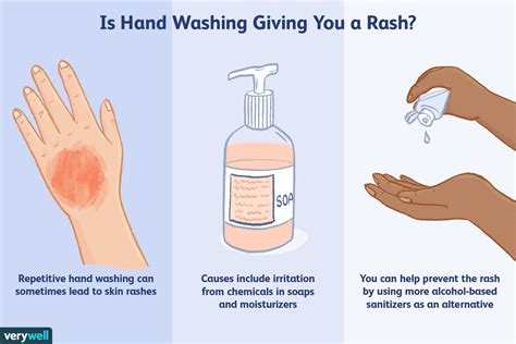Allergic Reactions To Hand Washing Rash On Hands Hand Hygiene