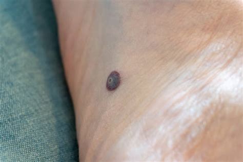 Foot Scab Stock Photos Pictures And Royalty Free Images Istock