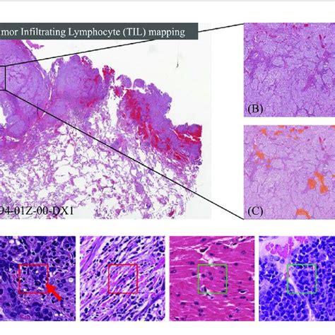 Identifying Tumor Infiltrating Lymphocyte Til Regions In Gigapixel