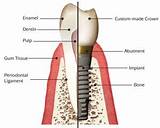 Dental Implant Payment Plans Images
