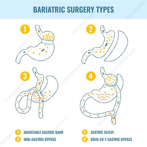 Bariatric Surgery Types Illustration Stock Image F