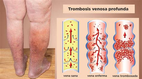 Trombosis venosa profunda qué es síntomas y tratamiento