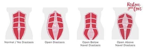 Diastasis Recti Surgery Procedure Overview Will You Need It Ryc