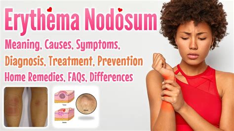 Erythema Nodosum Meaning Causes Symptoms Diagnosis Treatment