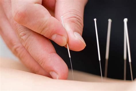 medical acupuncture and dry needling physio support