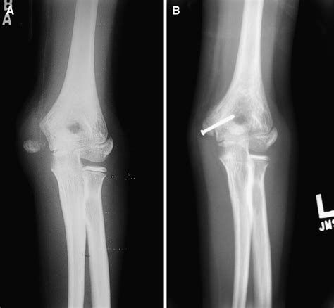 Acute Avulsion Fractures Of The Medial Epicondyle While Throwing In