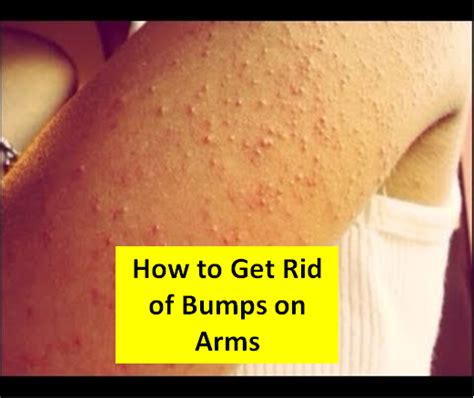 How To Get Rid Of Bumps On Arms Top 5 Diy Bumps On Arms How To Get
