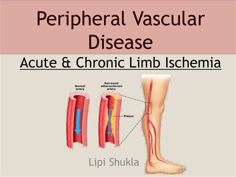 Peripheral Vascular Disease Acute And Chronic Limb Ischemia