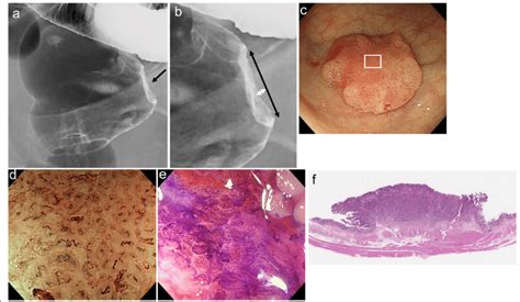 Radiographic Endoscopic And Histologic Features Of A Protruding Lesion