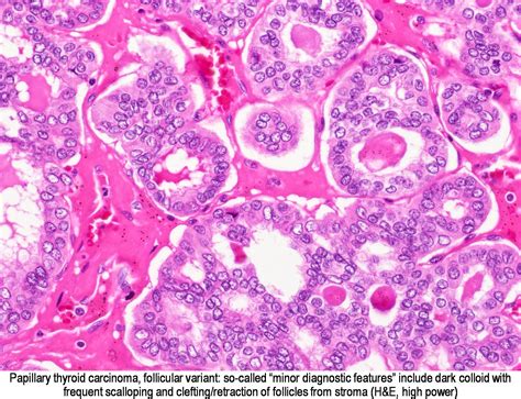 Pathology Outlines Papillary Carcinoma Follicular Variant
