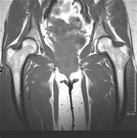 Steroid Induced Avascular Necrosis AVN Of The Hips Dr Lox
