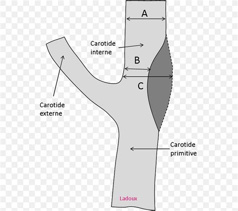 Carotid Artery Stenosis Common Carotid Artery Internal Carotid Artery
