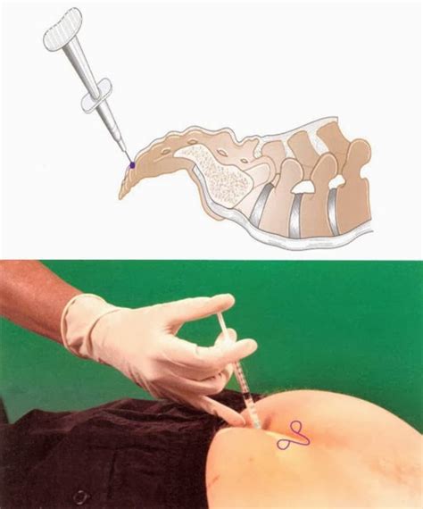 Sacrococcygeal Joint Injection Nursing