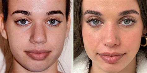 Rhinoplasty Before And After Nose Job Before And After