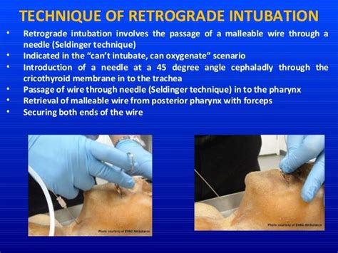 Alternative Technique Of Intubation Retromolar Retrograde Submental