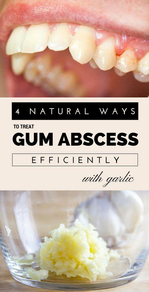 4 Natural Ways To Treat Gum Abscess Efficiently With Garlic In 2020