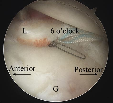 The glenoid cavity is shallow and contains the glenoid labrum which deepens it and aids in stability. View from anterior superolateral portal in a right ...
