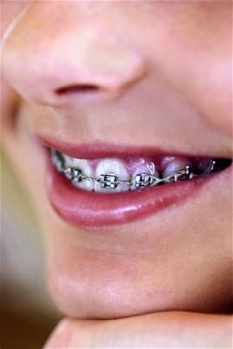 And i'm gunna get all my money back. Fake braces, Braces and You never know on Pinterest