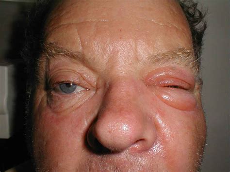 Periorbital Cellulits Note Marked Swelling And Redness Grepmed