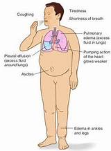 Photos of Treatment Of Congestive Heart Failure Includes