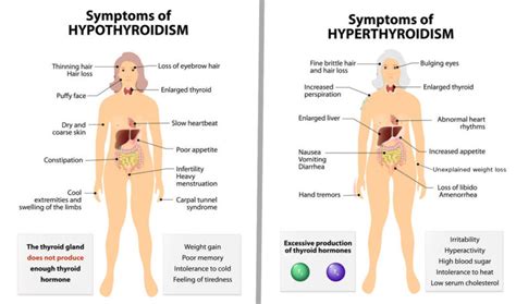 Hyperthyroidism Vs Hypothyroidism Symptoms Thyroid Disease Chart And Sexiz Pix