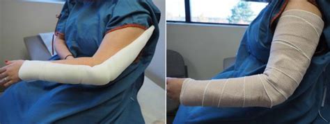 Elbow Fracture Specialist Clinic Singapore Sports Clinic