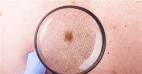 Woman 24 Recovering From Skin Cancer That Looked Like A Pimple