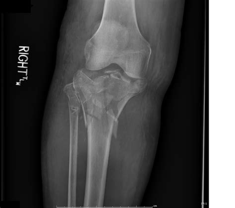 Intramedullary Nail Tibia Fracture Cpt Code Bios Pics