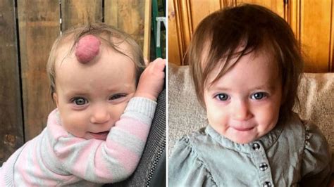 1 Year Old Girl Gets Blood Filled Tumor Removed From Forehead Good